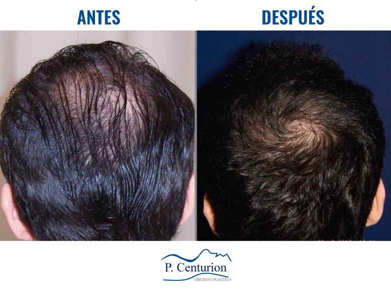 rejuvenecimiento de manos