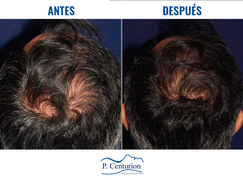 rejuvenecimiento de manos