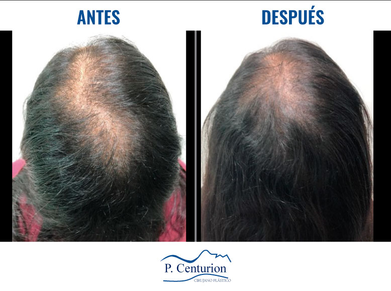 rejuvenecimiento de manos