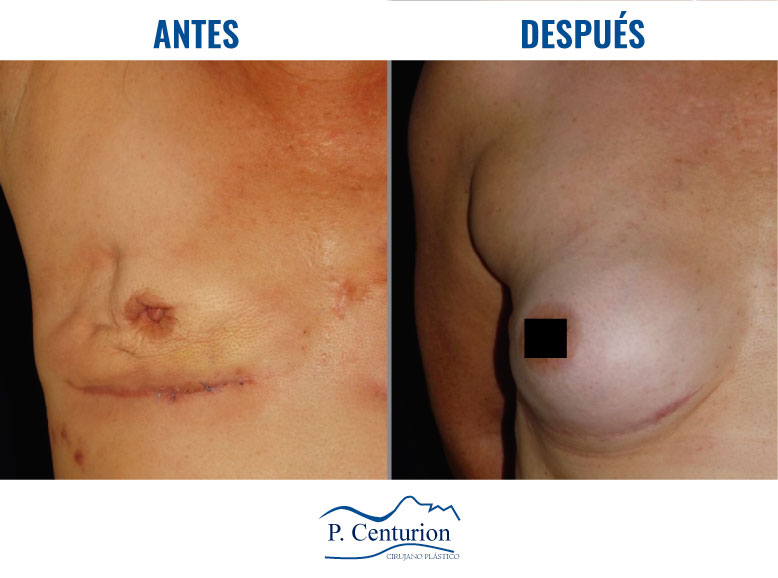 Reconstruccion mamaria con Células Madre