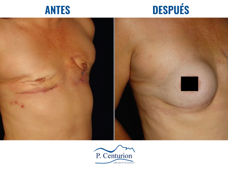 Reconstruccion mamaria con Células Madre