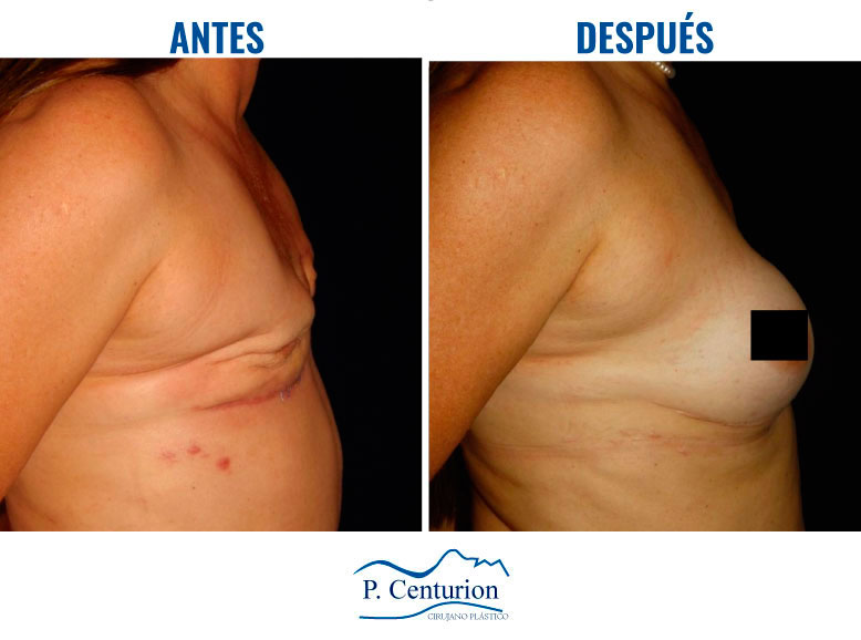 Reconstruccion mamaria con Células Madre
