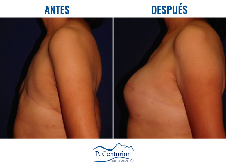 Reconstruccion mamaria con Células Madre