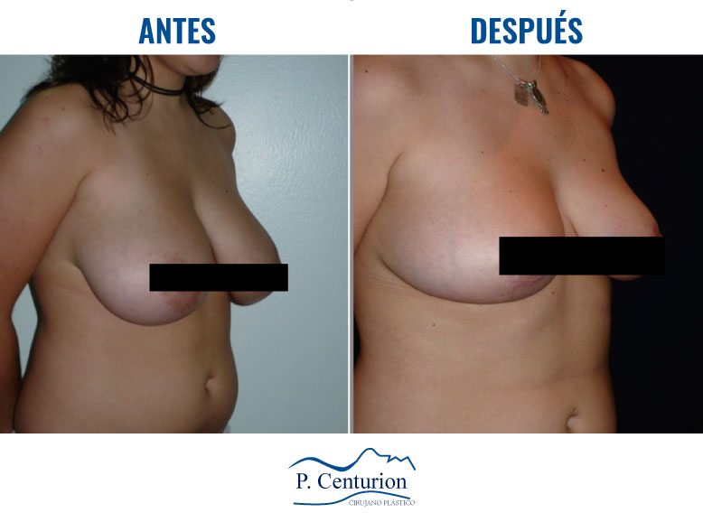 Reduccion y levantamiento mamario en Lima-Peru Dr.Centurion