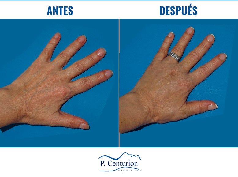 rejuvenecimiento de manos